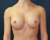 Feel Beautiful - Breast Augmentation Case 44 - After Photo